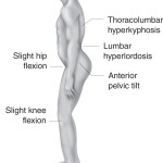 Muscle Imbalances for Endurance sports_lower_crossed_syndrome posture B