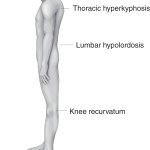 Muscle Imbalances for Endurance sports_lower_crossed_syndrome posture A